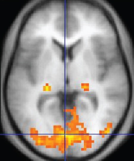 Functional magnetic resonance imaging scan showing blood-oxygen-level-dependent activation patterns in human brain cortex